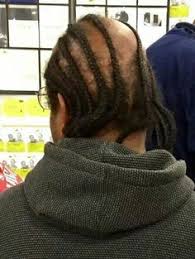 Cornrow Over Lol Hair Loss Bald Balding Mens Hairstyles Stylish Hair