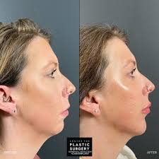 Small change, big impact! ✨ A chin implant can bring beautiful balance to  the face and completely transform a guest's profile. By enhancing the  chin's projection, this procedure helps create better facial