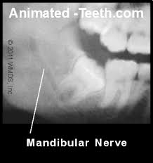 I wont need to get them taken out of my teeth after all. Paresthesia Nerve Damage After Wisdom Tooth Removal Or Injection Causes Duration Treatment