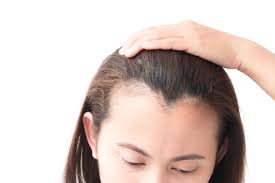This type of surgery can give you lasting results. How To Stop And Regrow A Receding Hairline Best Treatments Allure