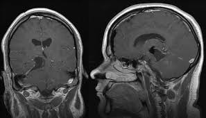 Klinik Und Poliklinik Fuer Neurochirurgie Gliome