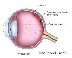 Maybe you would like to learn more about one of these? Floaters Flashes Retina Mount Vernon Northwest Eye Surgeons
