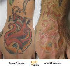 Giving This Client Their Hand Back About 80 There After 5 Treatments A Few More Will Still Be Needed But At This P Tattoo Removal Laser Tattoo Removal Tattoos