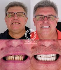 Mr. Hugh Spence selected Acardent Turkey for his treatment. He had All