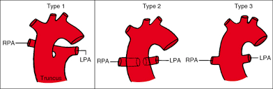 Truncus Arteriosus Thoracic Key