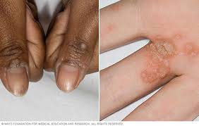 Image result for human papillomavirus symptoms