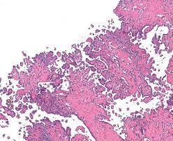 Literature search using the pubmed and plos one databases, . Figure 9 Malignant Mesothelioma In A Male Ntp Technical Report On The Toxicology And Carcinogenesis Studies Of Vinylidene Chloride Casrn 75 35 4 In F344 N Rats And B6c3f1 N Mice Inhalation Studies Ncbi Bookshelf