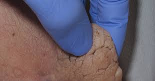 Dermapixel Fibroma Blando Quitar O No Quitar