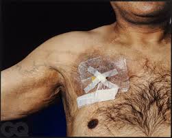 Well, we can add this to the list of weird things tattoos can do to your body: Scar Stories The Toll Of Colon Cancer Gq