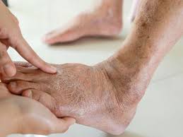 Image result for diabetic toes