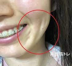 口横の線やくぼみにお悩みの女性へ 美容 美顔 ビューティーアドバイス