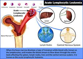 Learn about the causes and treatments here. Acute Lymphocytic Leukemia Prognosis Survival Rate Treatment Diagnosis