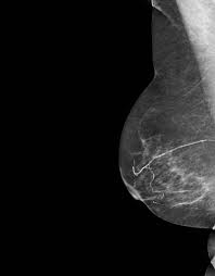 The disorder is primarily characterised by a deficiency in the development of the pectoral muscles in the chest. Poland Syndrome Radiology Case Radiopaedia Org