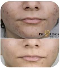 While transdermal application is the most popular use of microneedles, intraocular and intracochlear microneedle drug delivery systems are emerging. Skin Needling Microneedling Treatment Microneedling Melbourne Price Best Microneedling Treatment In Melbourne Best Microneedling Treatment In Sydney Skin Needling Melbourne Cost Skin Needling Melbourne Reviews