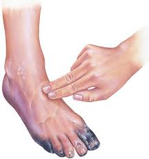 Image result for diabetic toes