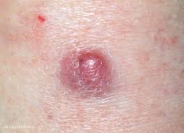 Maybe you would like to learn more about one of these? Merkel Zell Karzinom Altmeyers Enzyklopadie Fachbereich Dermatologie