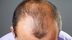 In a few cases, all the hair on the scalp is lost (alopecia totalis), or all body hair is lost (alopecia. Hair Loss Alopecia Medical Skin Conditions Medical Dermatology Apex Dermatology Denver Co