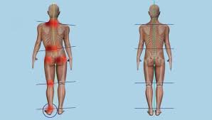 Image result for Functional Leg Length Discrepancy