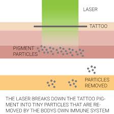 Get your free consultation in our clinic or online. We Explain The Basics Of Tattoo Removal Using Laser Technology