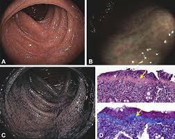 Image result for Microscopic Colitis