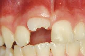 Image result for Tooth Luxation