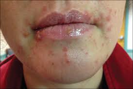 Many viruses can cause a viral rash in addition to other symptoms such as fever and cough. Rapidly Progressing Rash In An Adult Photo Quiz American Family Physician