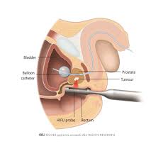Although it is the most commonly diagnosed cancer in american women, breast cancer can impact people of all genders. Know Everything About Prostate Cancer Patient Information