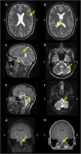In fact, researchers and medical professionals consider mri to be one of the biggest breakthroughs in the field of multiple sclerosis, since it makes it possible to see lesions on the brain and spinal cord. Stress Cardiomyopathy Associated With The First Manifestation Of Multiple Sclerosis A Case Report Bmc Neurology Full Text