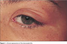 Image result for Dacryoadenitis