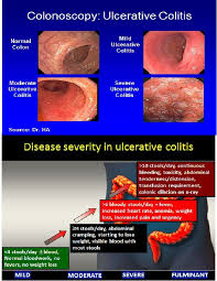Side By Side Comparison Of Ulcerative Colitis Colonoscopy View With Symptoms Ulcerative Colitis Colitis Colonoscopy