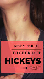 How To Get Rid Of Hickeys Secret Methods How To Get Rid Of Hickeys Trong 2020 Nhiếp ảnh