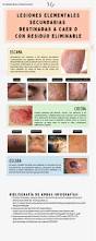 Image result for dermatitis contacta allergica