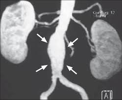 À medida que o sangue passa pela porção enfraquecida do vaso, ele se dilata ou incha e, se isso continuar, pode se romper, o que pode ser muito fatal. Aneurisma Da Aorta Abdominal Infra Renal Que Nao Envolve As Arterias Download Scientific Diagram