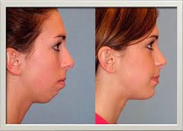 Cosmetic Surgery What Is Cheek Augmentation Its Benefits And Recovery Chin Implant Plastic Surgery Cosmetic Surgery