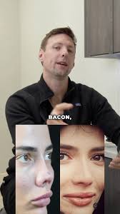 Kevin Bacon may need a nose job. 👇🏼, This over rotation that you see in  the nose is fixed by something called a “rib graft.” In these cases, the  surgeon removes cartilage from the ribs and uses it to ...