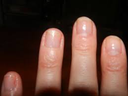 A blogger has revealed how she restored her bleeding and cracked nails after ripping off her acrylics. How To Heal Nails After Acrylics