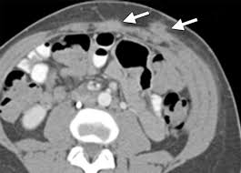 The ct scan revealed a contrast. Endometriosis Of Abdominal And Pelvic Wall Scars Multimodality Imaging Findings Pathologic Correlation And Radiologic Mimics Radiographics