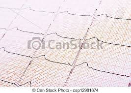 Heart Rhythm Chart