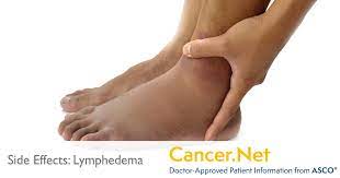 I had one round of chemo and i did have some issues that hung around for a long time, but nothing like neuropathy in my feet. Fluid Retention Or Edema Cancer Net