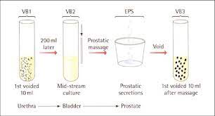 Chronic bacterial prostatitis involves recurring infections in the it's usually detected when the patient is tested for a urinary tract infection or reproductive tract disorder. The Figure Shows The Standard Meares Stamey Test Procedure Download Scientific Diagram