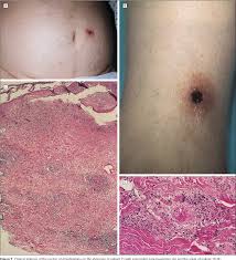 Image result for Rickettsialpox