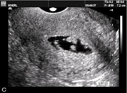 Image result for corpus luteum sonography)