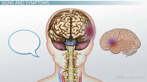 Numbness can occur along a single nerve on one side of the body, or it may occur symmetrically, on both sides of the body. Blood Clot In The Brain Symptoms Signs Treatment Video Lesson Transcript Study Com