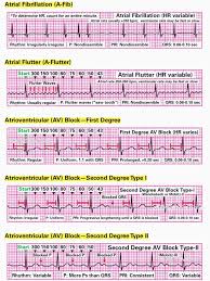 Image result for Electrocardiogram Validity