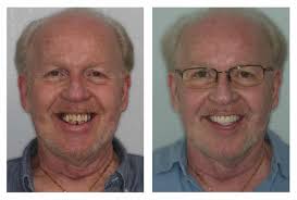 Same Day Teeth® Smile Gallery