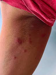 Image result for Cimex lectularius bites