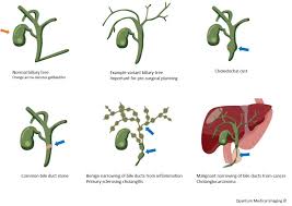 This damage can lead to liver failure. Mrcp The Fine Art Of Imaging The Pancreato Biliary Tree Quantum Medical Imaging