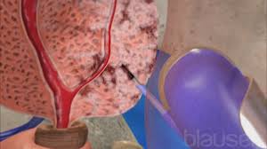 The results are usually reported as nanograms of psa per milliliter (ng/ml) of blood. Prostate Cancer Kidney And Urinary Tract Disorders Merck Manuals Consumer Version