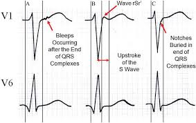 Image result for Epsilon Wave
