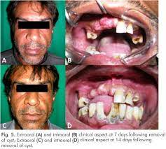 Scielo Brasil Lateral Periodontal Cyst With Extremely Rare Clinical Radiographic Presentation Lateral Periodontal Cyst With Extremely Rare Clinical Radiographic Presentation